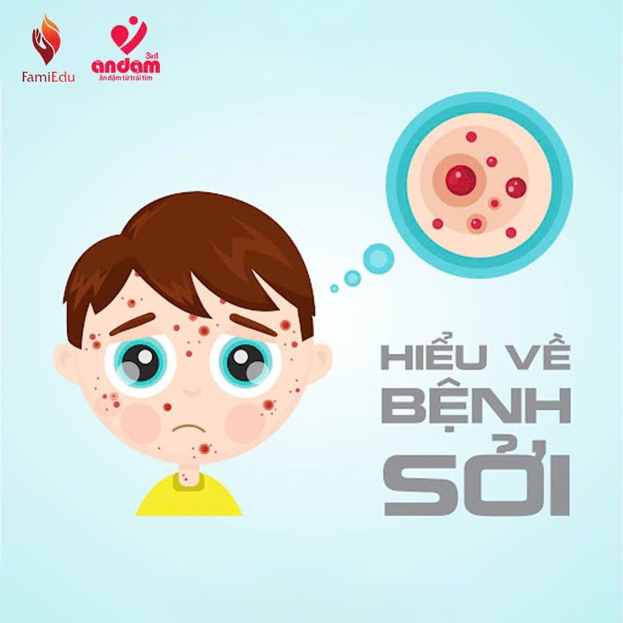 HIỂU VỀ BỆNH SỞI